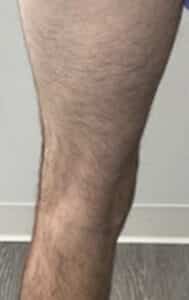 Varicose Veins