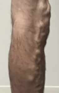 Varicose Veins