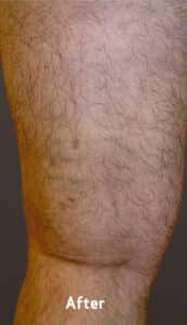 Varicose Veins