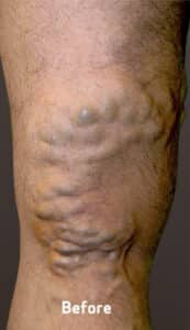 Varicose Veins