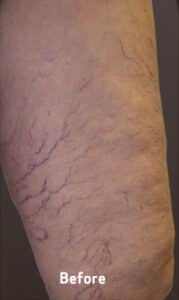 Spider Veins