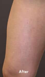 Varicose Veins