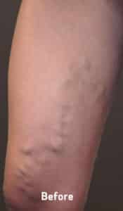 Varicose Veins