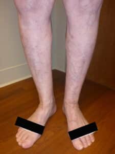 Large Vein Disease