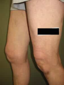 Large Vein Disease