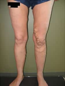 Large Vein Disease